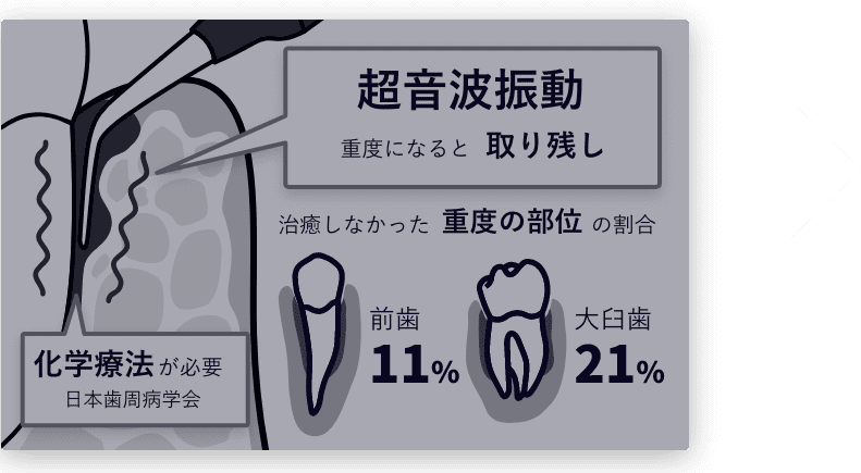 超音波振動のみ