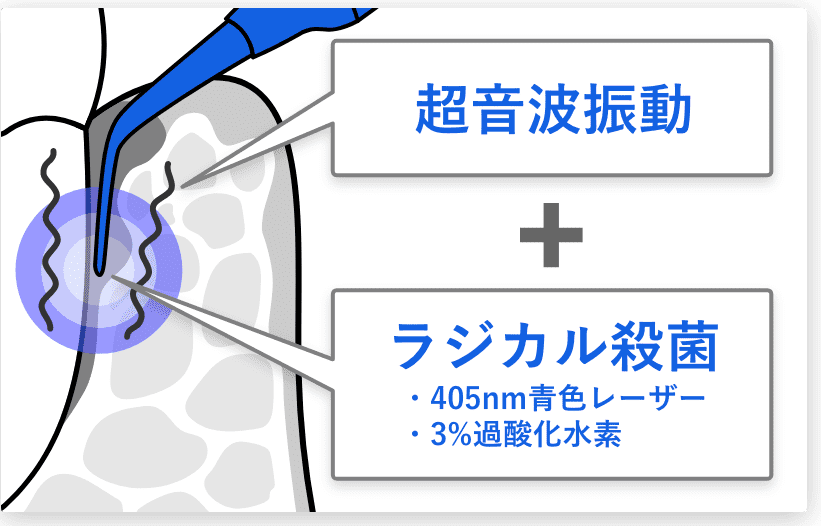 超音波振動 + ラジカル殺菌
