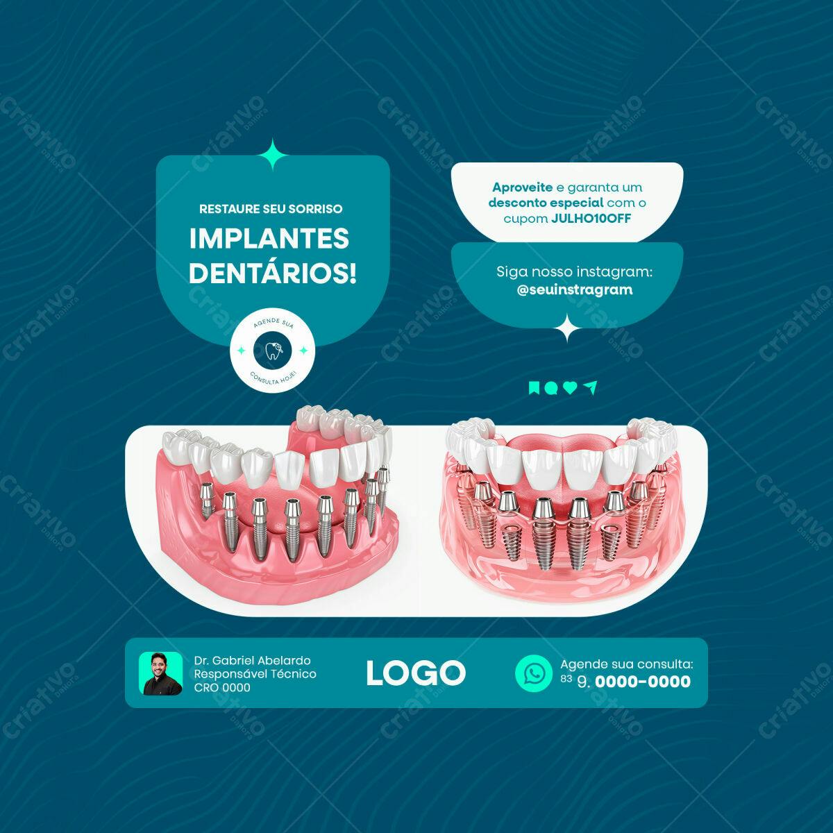 Post para Implantes Dentários PSD Editável