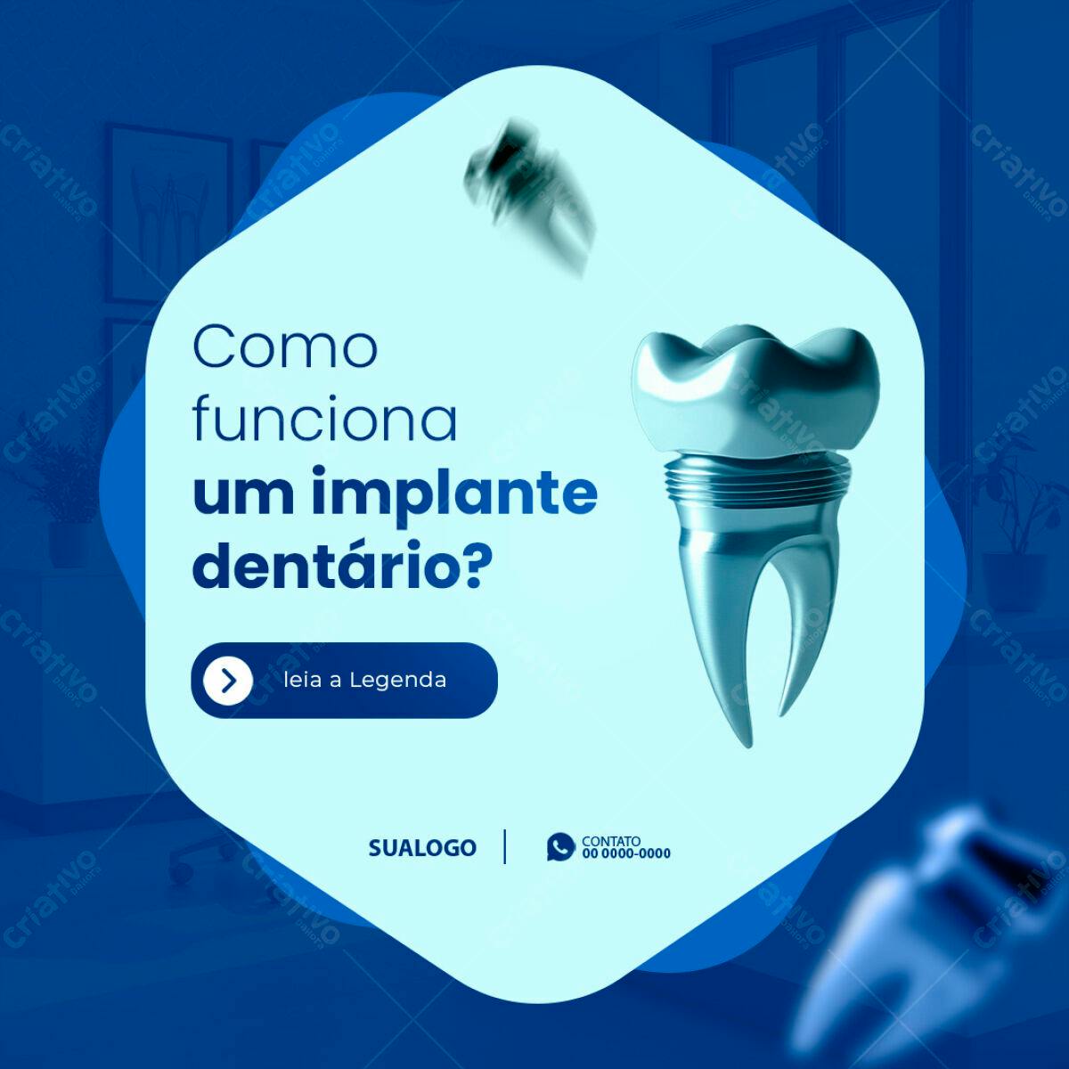 Banner Odontológico Implante Dentário PSD Editável