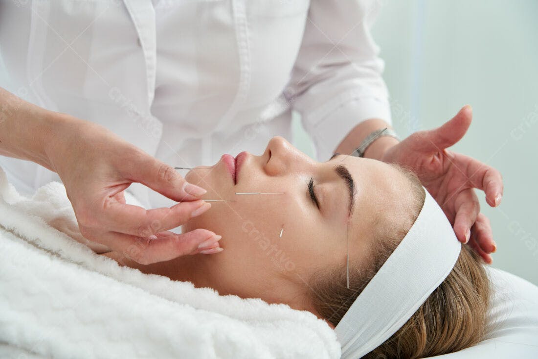 Acupuntura facial mulher jovem