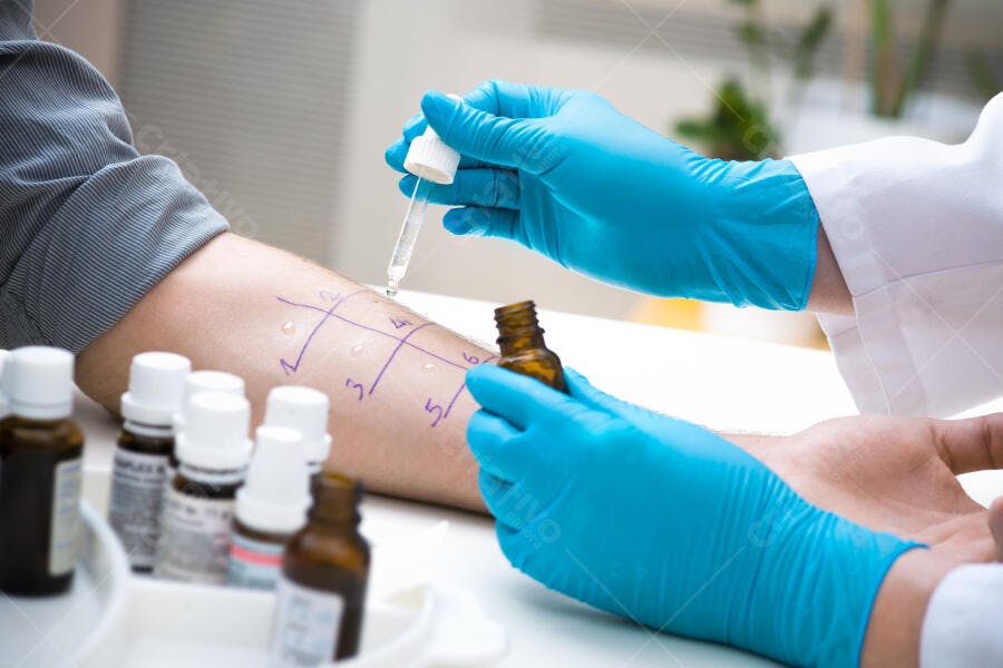 Teste de Alergia Cutâneo braço paciente