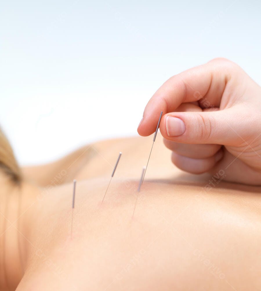 Acupuntura tratamento costas mulher