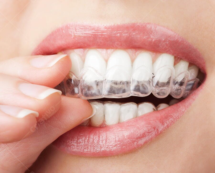 Alinhadores transparentes para dentes brancos