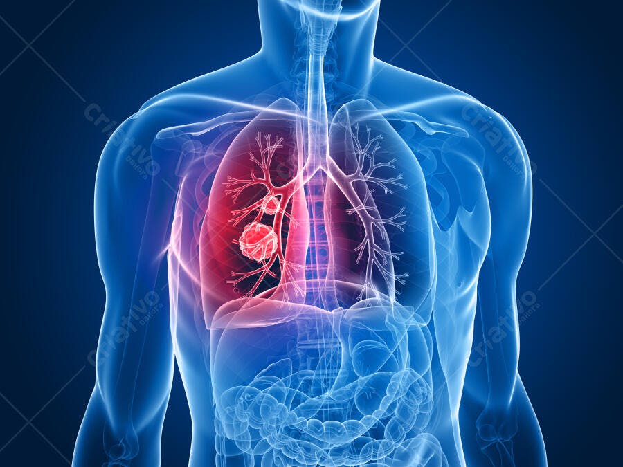 Tumor Pulmonar Ilustração Médica