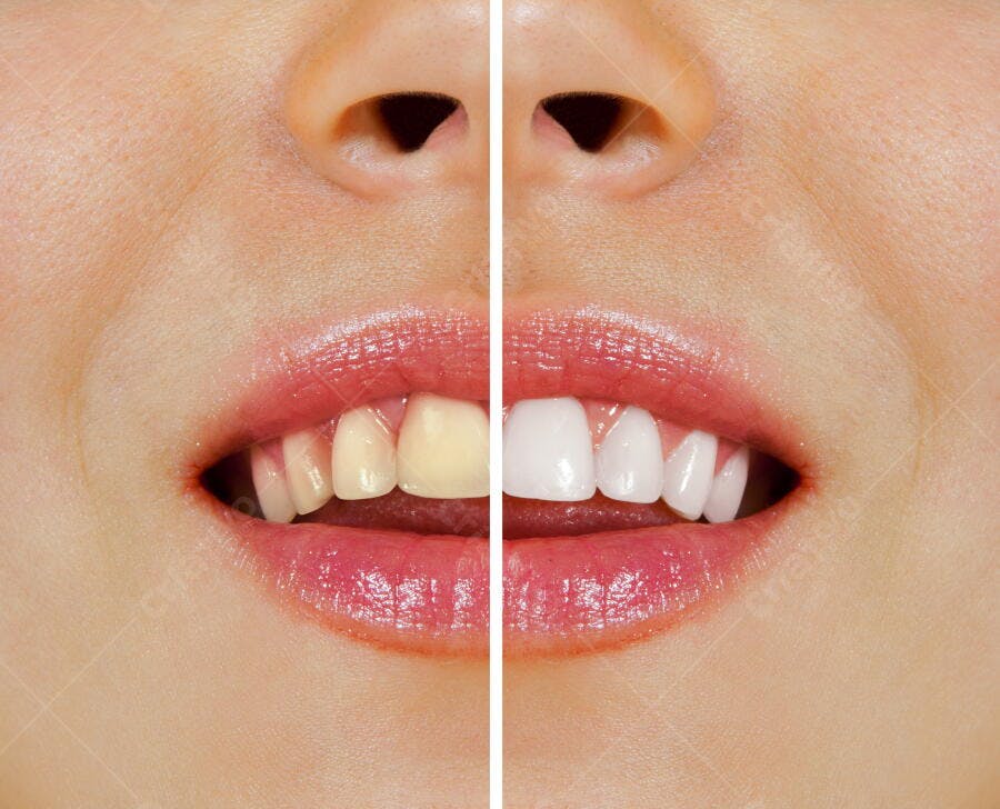 Clareamento dental antes e depois
