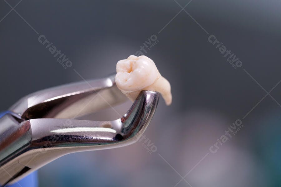 Dente extraído em pinça odontológica