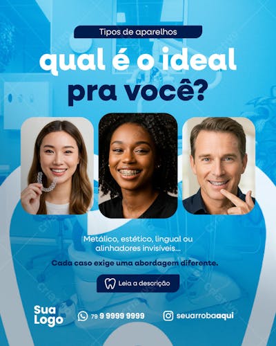 Tipos de aparelhos qual é o ideal pra você