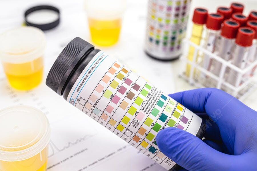 Mão com luva azul segurando frasco de teste de urina em laboratório médico