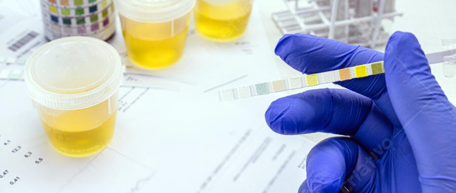 Mão com luva azul segurando tira reagente de exame de urina em laboratório médico