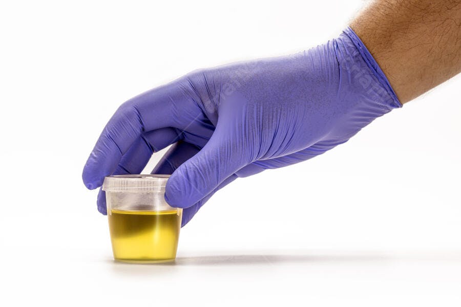 Mão com luva azul de profissional de saúde segurando frasco de amostra de urina para exame