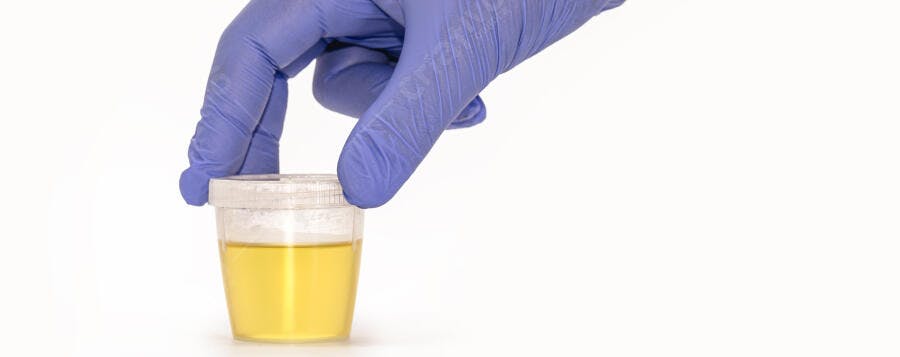 Mão com luva azul segurando amostra de urina para exame médico laboratorial