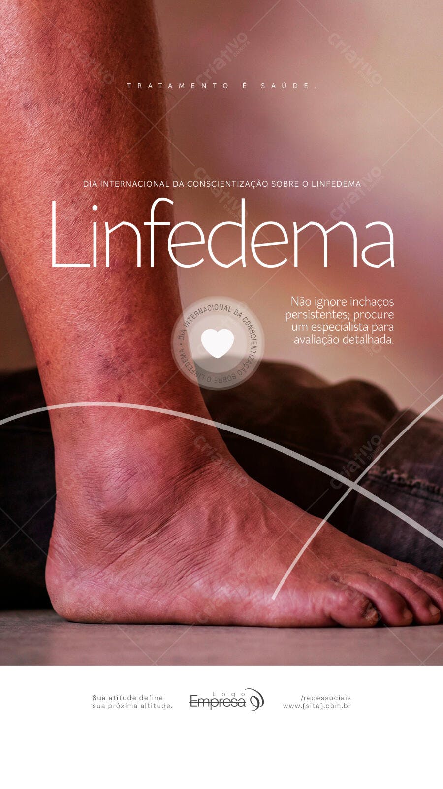 Story Linfoedema Conscientização Saúde PSD Editável